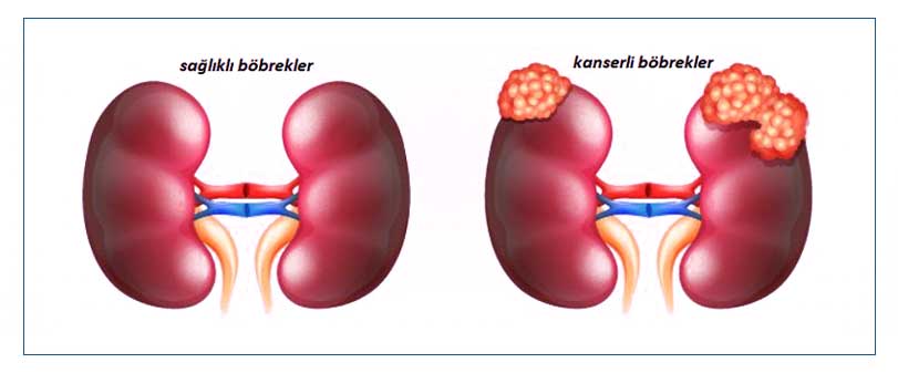böbrek kanseri