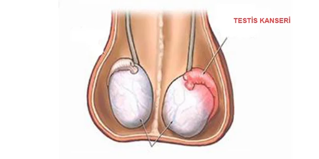 testis kanseri