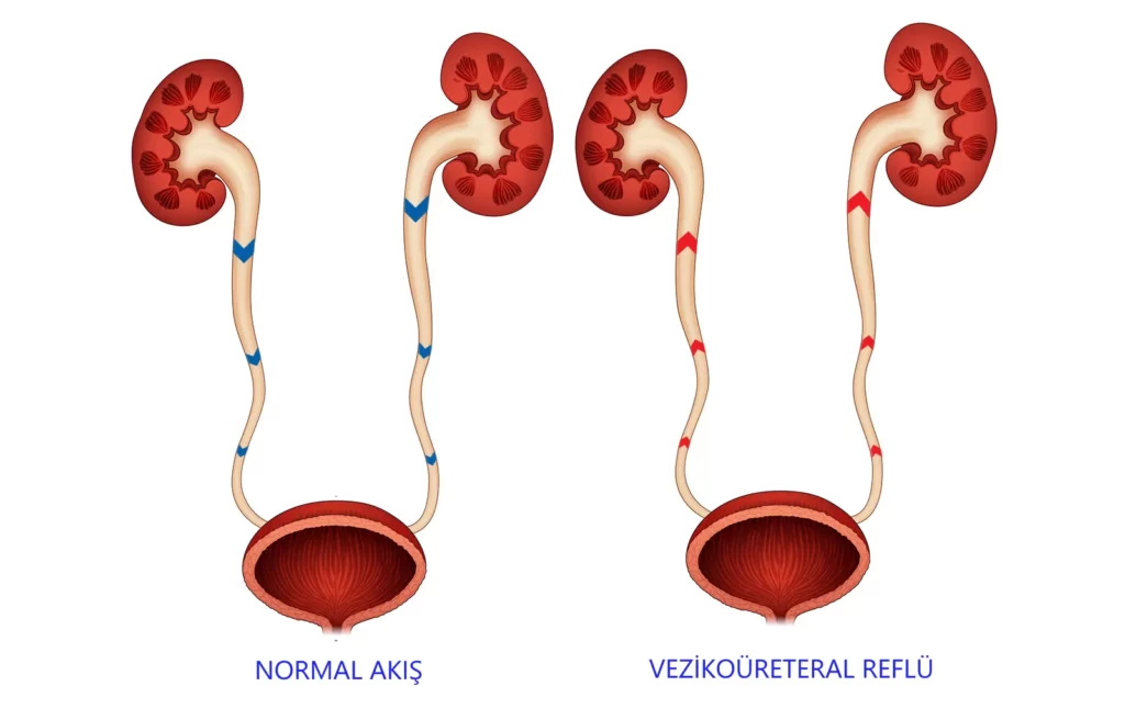 vezikoüreteral reflü